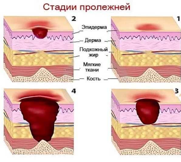 Стадии пролежней