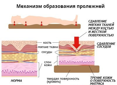 Механизм образования пролежней